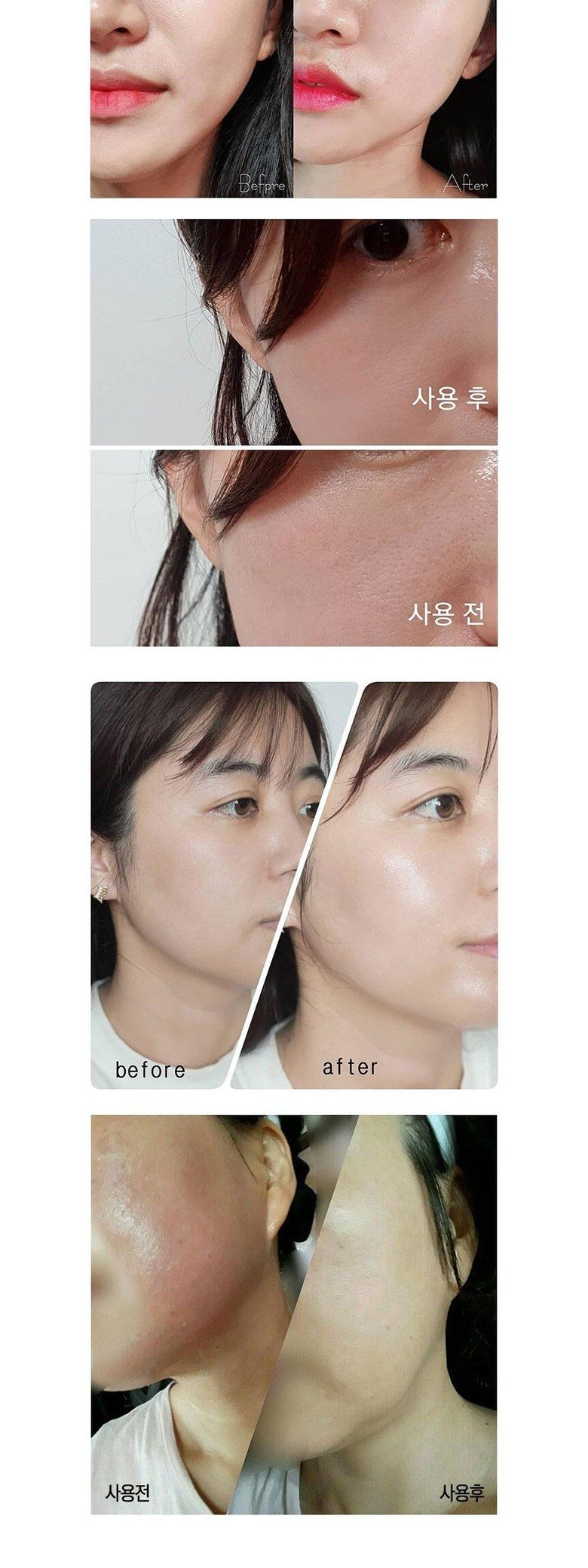 VISS RF 고주파마사지기
